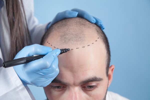 How much does a hair transplant cost in Spain? 2 How much does a hair transplant cost in Spain?