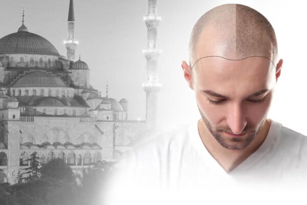 Hair transplant in Turkey, why choose this country?