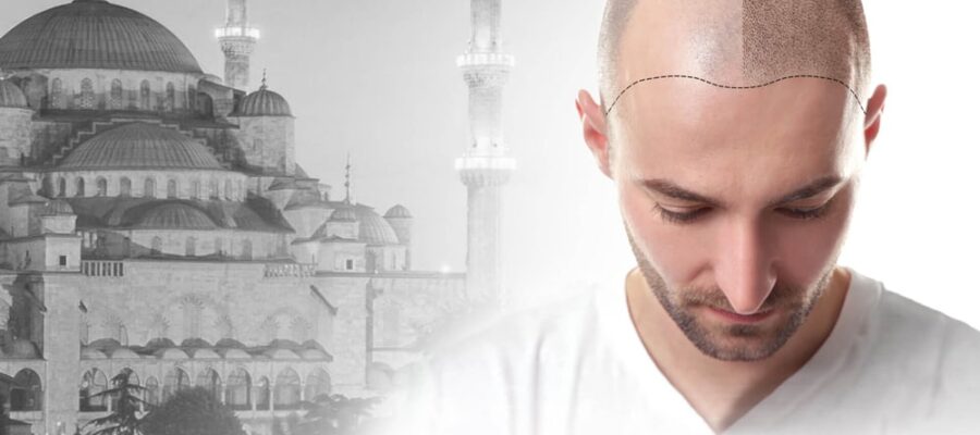 Hair transplant in Turkey, why choose this country? 1 Hair transplant in Turkey, why choose this country?