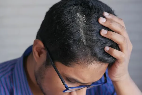 Does dandruff affect hair transplants?