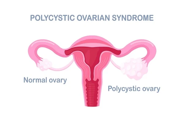 Relationship between Polycystic Ovary Syndrome and hair loss 1 Relationship between Polycystic Ovary Syndrome and hair loss