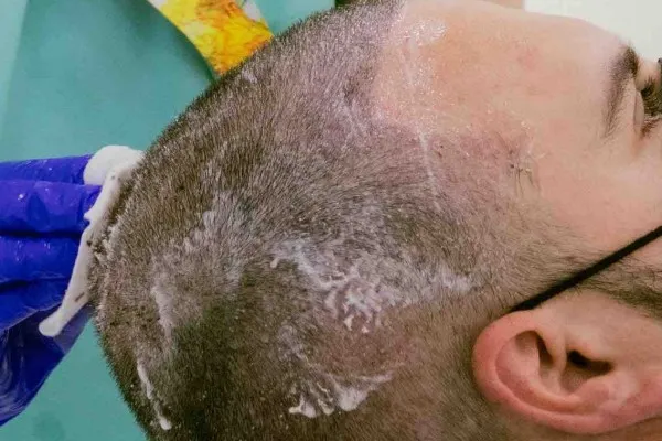 How to get the best hair transplant in London?