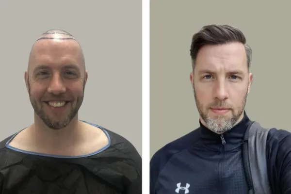 Hair transplant surgery in Turkey: Reviews and experience sharing 4 Hair transplant surgery in Turkey: Reviews and experience sharing