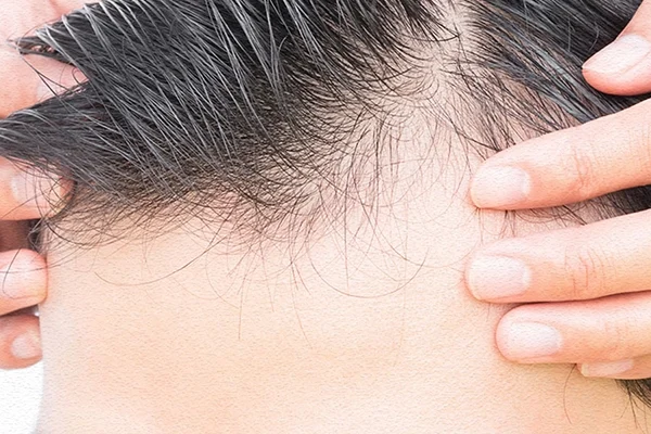 Exosome Hair Therapy