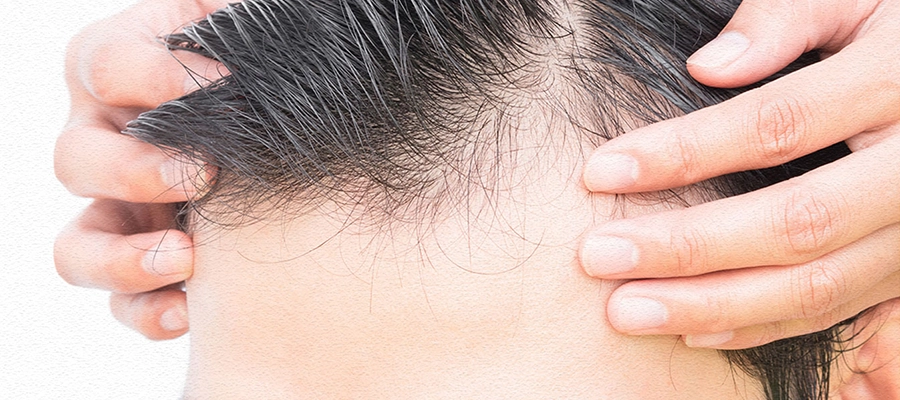 Exosome Hair Therapy 1 Exosome Hair Therapy