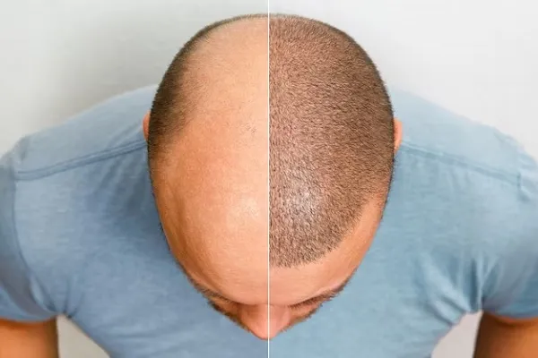 How to get the best hair transplant in London?