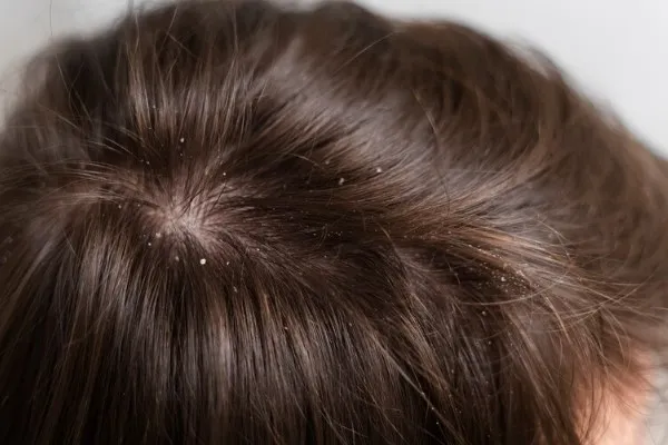 Does dandruff affect hair transplants?