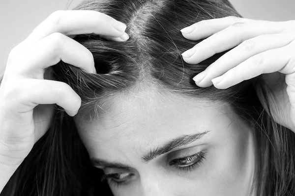 Androgenetic Alopecia in young women