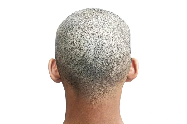 What to do about Alopecia in young people? 1 What to do about Alopecia in young people?