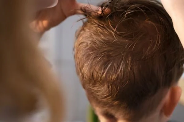 Alopecia in Children: Causes and Treatments 3 Alopecia in Children: Causes and Treatments