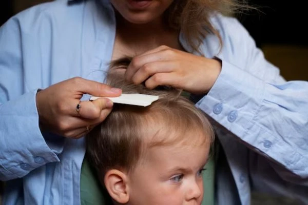 Alopecia in Children: Causes and Treatments 7 Alopecia in Children: Causes and Treatments