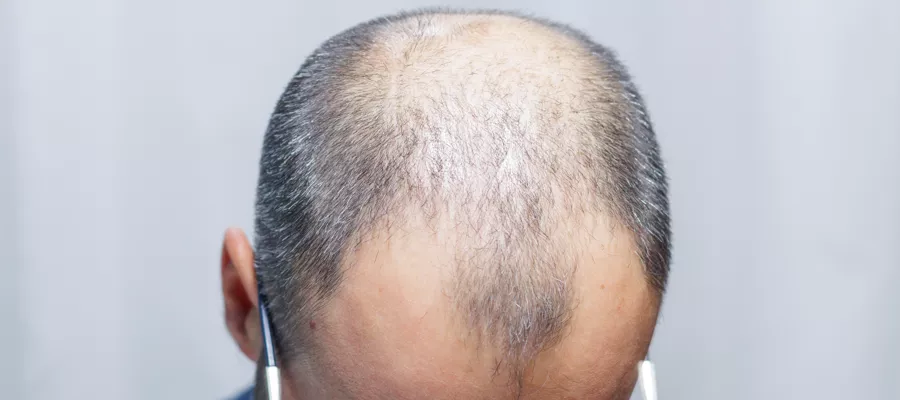 Can You Get a Hair Transplant with White Hair?