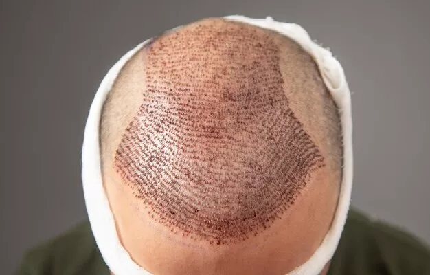 Hair transplant at 50 or 60: Is it effective? 5 Hair transplant at 50 or 60: Is it effective?