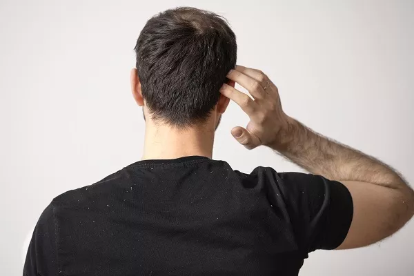 How to treat Dandruff in Men? Natural remedies