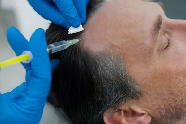 Hair transplant at 50 or 60: Is it effective? 3 Hair transplant at 50 or 60: Is it effective?