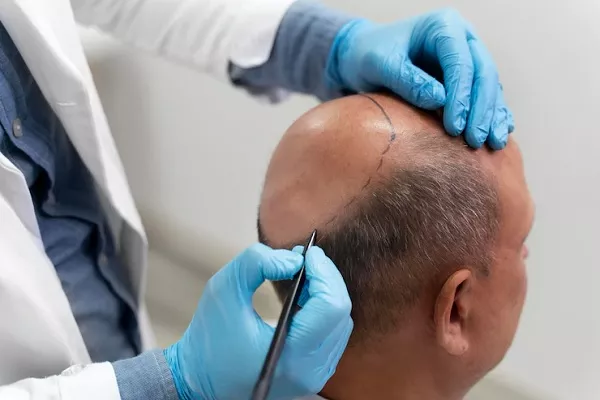 Hair transplant at 50 or 60: Is it effective? 1 Hair transplant at 50 or 60: Is it effective?