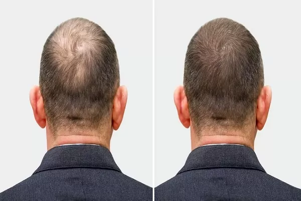 Hair transplant at 50 or 60: Is it effective? 4 Hair transplant at 50 or 60: Is it effective?