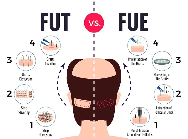 Is the hair transplant permanent?
