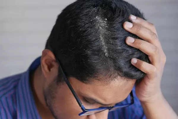 How to treat Dandruff in Men? Natural remedies