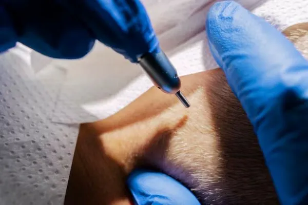 Hair transplant for men: What types are there? 5 Hair transplant for men: What types are there?