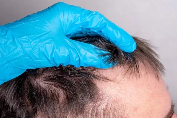 Shedding Effect, does it harm our Hair?