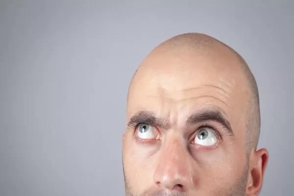 Shock Loss after a Hair Transplant 2 Shock Loss after a Hair Transplant