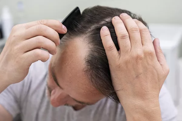 Styling your hair causes Baldness? Tips to avoid it