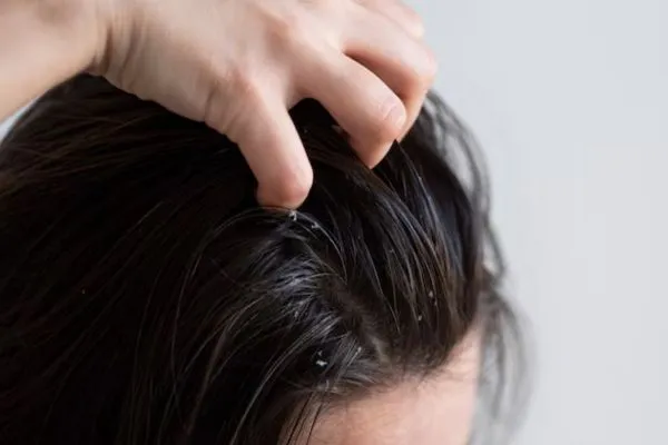 Does dandruff affect hair transplants?