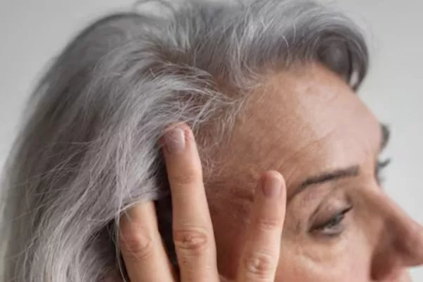 Alopecia In Menopause 2 Alopecia In Menopause