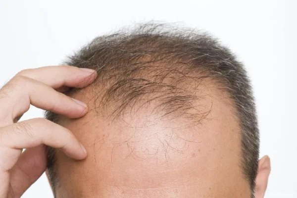 Tipos de alopecia