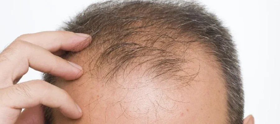 Tipos de alopecia 1 Tipos de alopecia