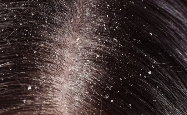 Los problemas más comunes del cabello y su solución 4 Los problemas más comunes del cabello y su solución