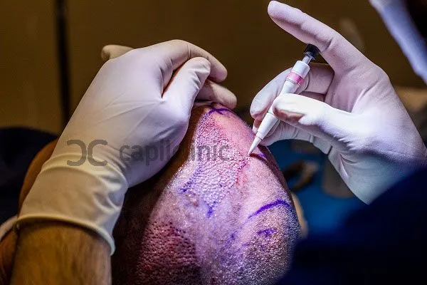 El microinjerto capilar en Turquía 3 El microinjerto capilar en Turquía