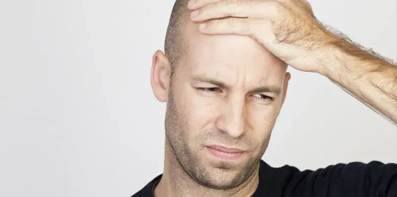 ¿Cuáles son los mejores tratamientos para la alopecia en la actualidad?