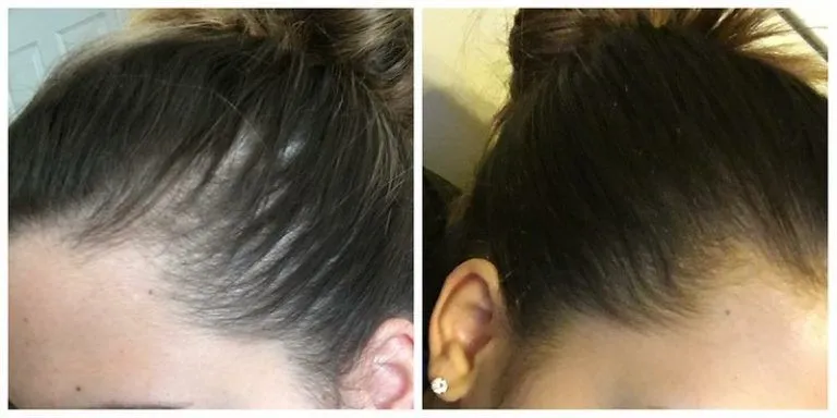 Bicalutamida para la alopecia femenina 2 Bicalutamida para la alopecia femenina