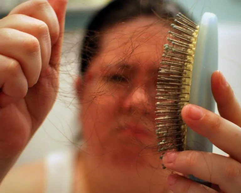 Famosas que sufren alopecia