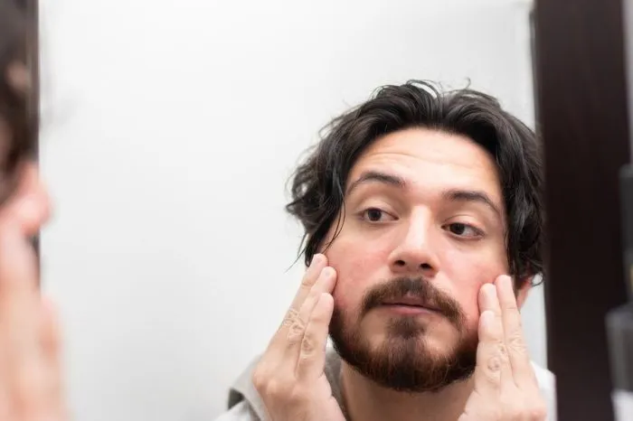 Acné sur la tête, symptômes et traitements