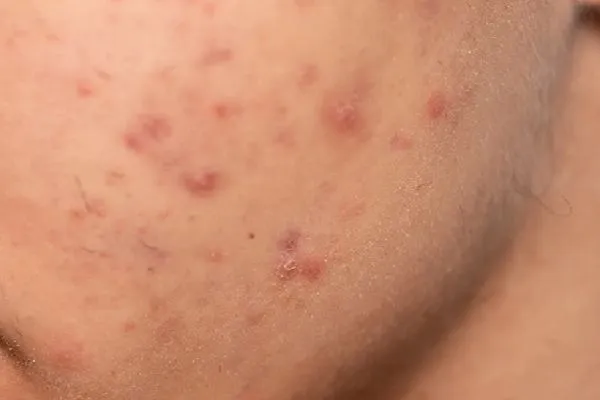 Alopecia frontal fibrosante cambios en la piel