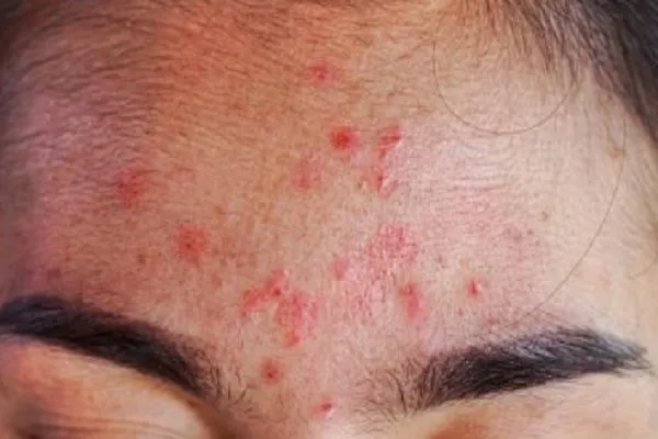 Alopecia frontal fibrosante cambios en la piel