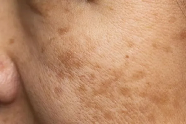 Alopecia frontal fibrosante cambios en la piel