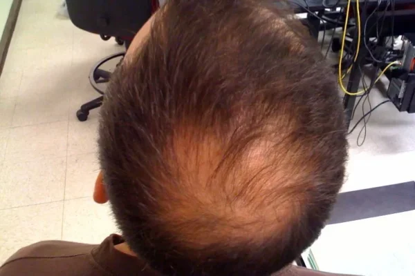 Alopecia androgénica: qué es, causas y tratamientos