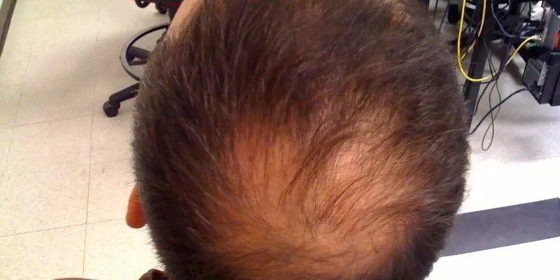 Alopecia androgénica: qué es, causas y tratamientos 1 Alopecia androgénica: qué es, causas y tratamientos