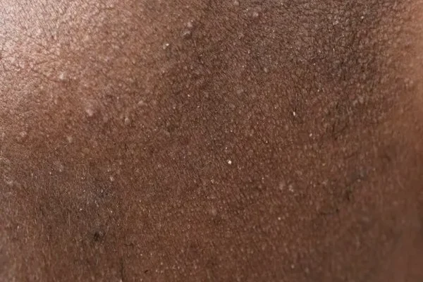 Boutons sur le cuir chevelu greffe de cheveux