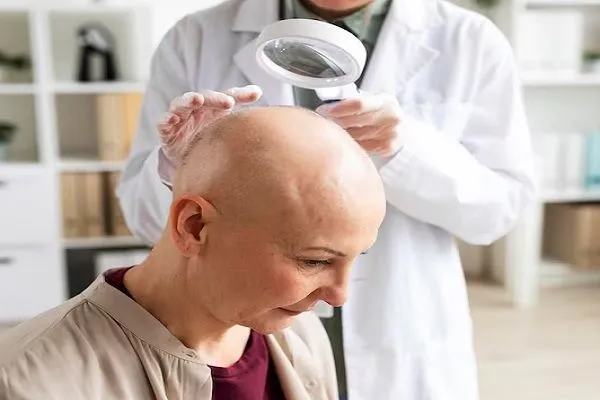 Cáncer y pérdida del pelo