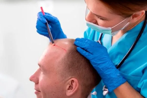 Comment se déroule une greffe de cheveux étape par étape en clinique 5 Comment se déroule une greffe de cheveux étape par étape en clinique