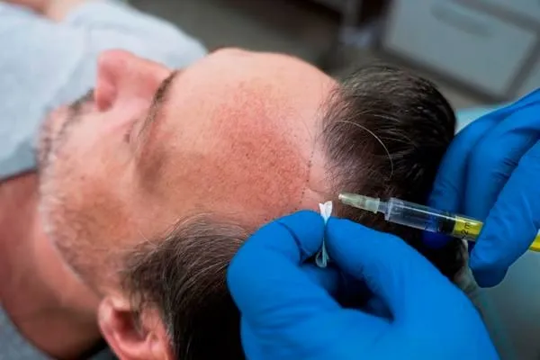 Comment se déroule une greffe de cheveux étape par étape en clinique 3 Comment se déroule une greffe de cheveux étape par étape en clinique