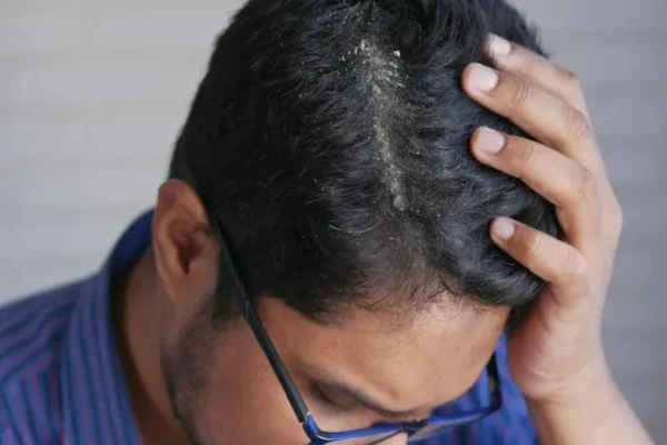 Comment traiter les pellicules chez les hommes ?