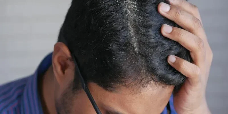 Comment traiter les pellicules chez les hommes ? 1 Comment traiter les pellicules chez les hommes ?