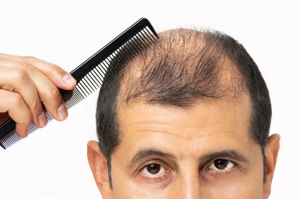 Minoxidil pastillas y finasteride ¿Es posible ingerirlas a la vez?