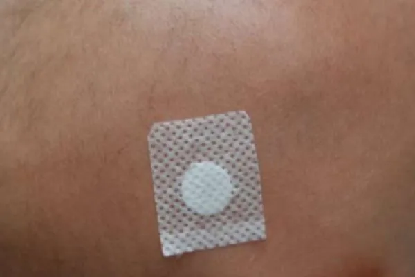 Difenciprona, inmunoterapia para alopecia areata 2 Difenciprona, inmunoterapia para alopecia areata